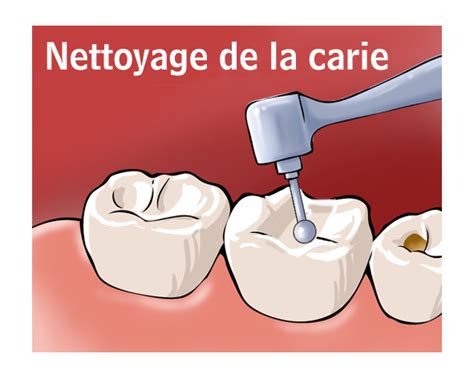 Caries Et Soins Des Caries