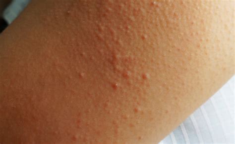 Keratosis Pilaris Chicken Skin — Medical Secrets