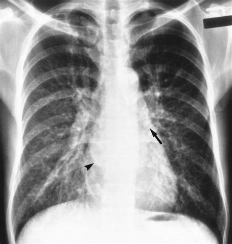 Mitral Regurgitation Chest X Ray Wikidoc 50 Off