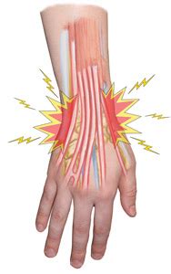 Wrist Extensor Tendonitis