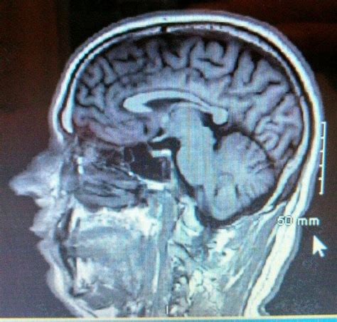 13 best encephalomalacia images on Pinterest | Mri brain, Alternative ...