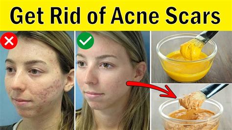 How To Get Rid Of Acne Scars On Face At Home Home Remedies For Acne