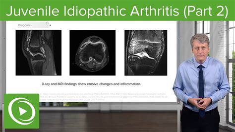 Juvenile Idiopathic Arthritis Xray