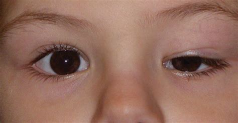 Paediatric Eye Conditions Ptosis Thoneh