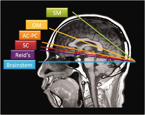 Posterior Commissure Mri