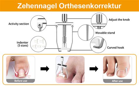 Eingewachsene Zehenn Gel Set Zehennagel Korrektur Patch Korrektor