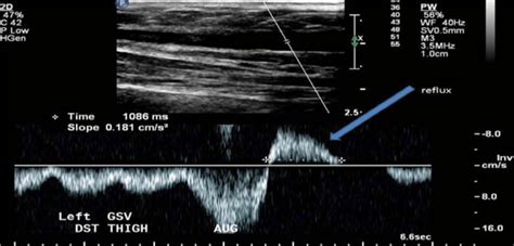 Venous reflux ultrasound - polkrealtime