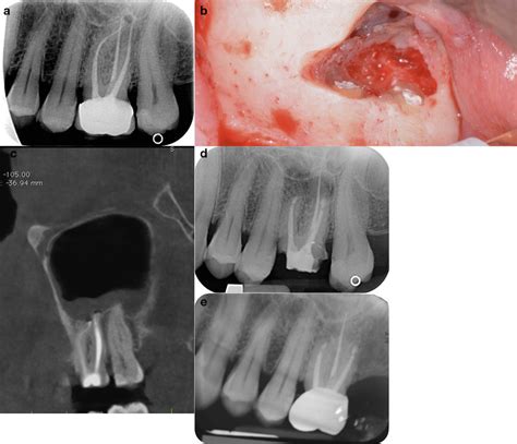 A Pre Operative Periapical Radiograph Of 2 6 Showing A Small Apical