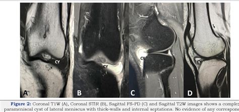 Figure 2 From High Resolution Ultrasonography Diagnosis Of Meniscal