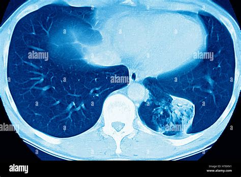 LUNG CANCER, MRI Stock Photo - Alamy