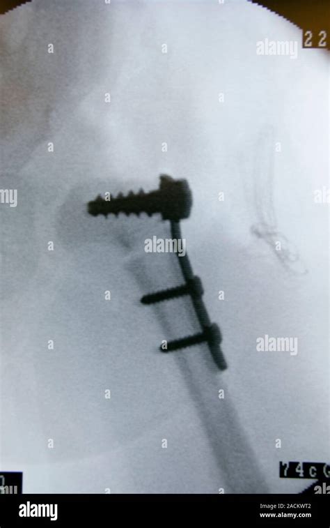 Congenital Hip Dislocation Surgery X Ray Of The Hip Of A 15 Month Old