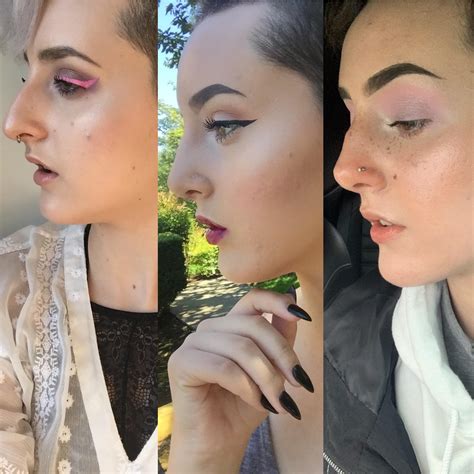 Before, 3 week post, and 3.5 years post nasal reconstruction by Dr