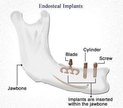 Different Types Of Dental Implants