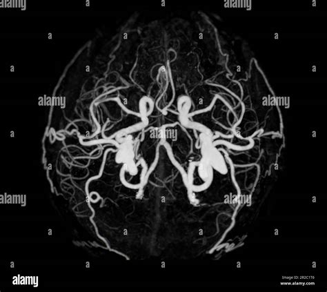 Ct Angiography Of The Brain Or Cta Brain Showing Cerebral Artery Stock