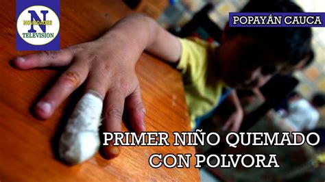 Primer Ni O Quemado Con Polvora En Popayan Podr A Perder Dos De Sus