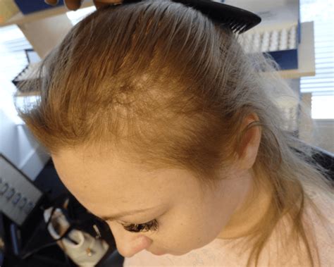 diffuse thinning  symptoms treatment  hair loss centre