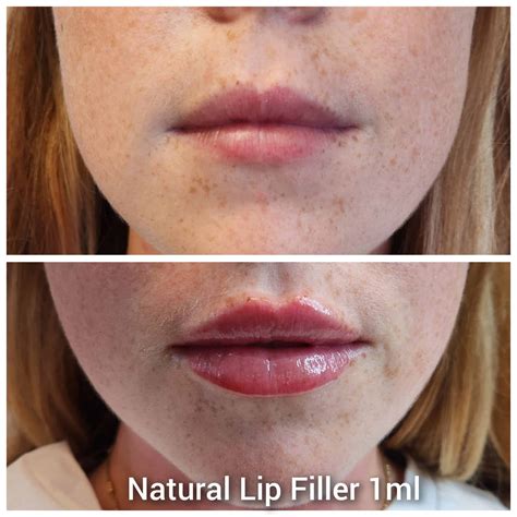 Lip Fillers London