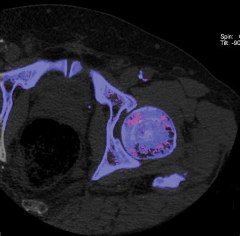 Photon Counting Detector Ct System Design And Clinical Applications Of