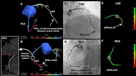 Frontiers Case Report Invasive And Non Invasive Hemodynamic