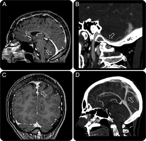 Teaching NeuroImages Chronic Sinus Thrombosis With Patency Of