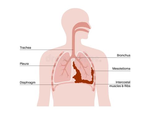 Mesothelioma Cancer Disease Stock Vector Illustration Of Respiratory