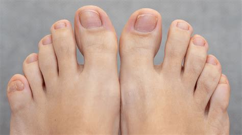 Broken Pinky Toe Symptoms Treatment And Other Conditions 52 Off