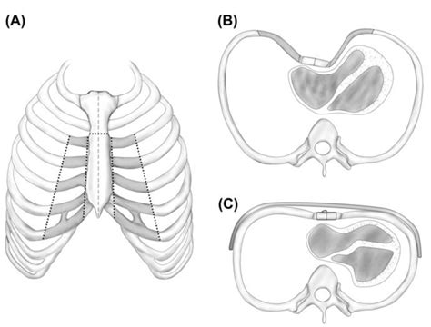 Schematic Representation Of The Surgically Corrected Pectus Excavatum