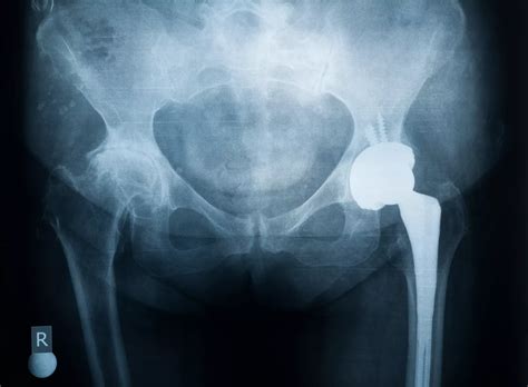 Signs You May Need A Hip Replacement Austin Tx Orthopaedic