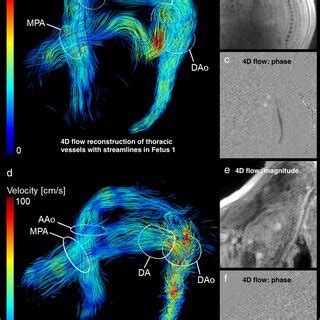 D Flow Mri Based Characterisation Of Flow Dynamics End Diastolic