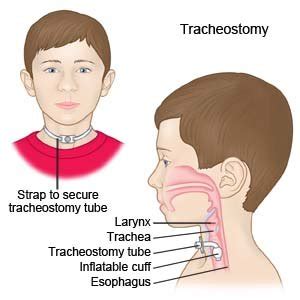 Tracheostomy Tube