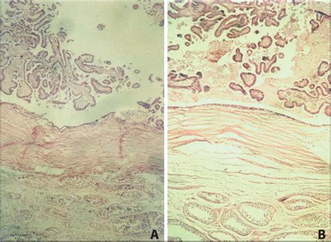 Figure From A Diagnostic Pitfall Of Fine Needle Aspiration Cytology