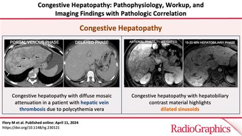 Congestive Hepatopathy Pathophysiology Workup And Imaging Findings With Pathologic