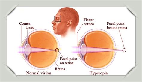 Hyperopia Definition Causes And Treatment Baybooks