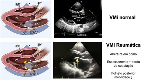 Estenose Mitral Degenerativa X Reum Tica Aspectos Ecocardiogr Ficos