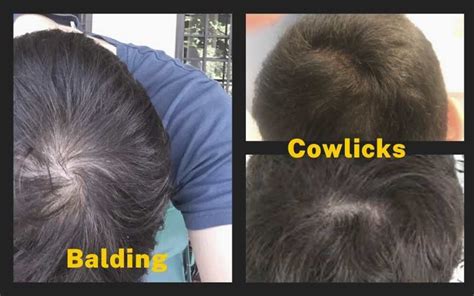 How To Tell If Youre Going Bald The Bald Company