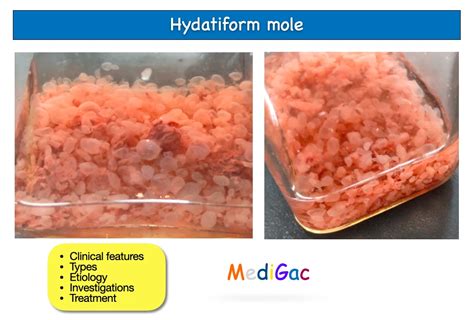 Hydatidiform mole – Clinical features | Types | Pathophysiology ...