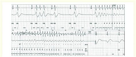 Implantable Cardioverter Defibrillator Record Atlas Tm þ Vr V 193