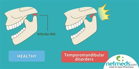 Tmj Temporomandibular Joint Disorders Symptoms And More 58 Off