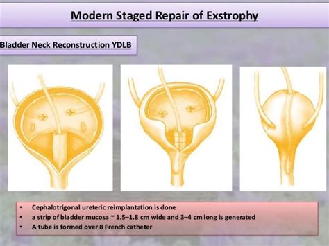 Exstrophy Epispadias Complex Msre And Cpre