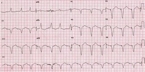 ECG Quiz: Drug-induced torsades de pointes – Dr John M