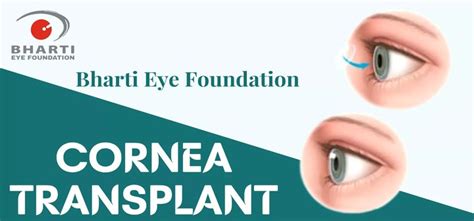 Cornea Transplant Surgery What You Need To Know Health Nigeria