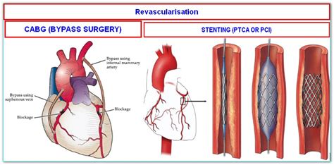 Bypass Surgery Cardiac Wellness Institute