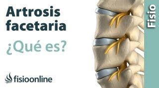 Artrosis Lumbar Qu Es Causas S Ntomas Tratamiento Y Consejos