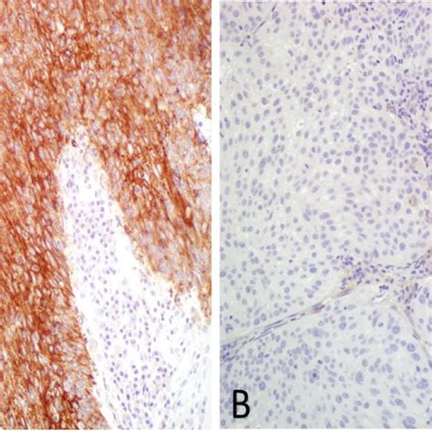 Cervical Tumors With Pd L1 Expression A And Without Pd L1 Expression