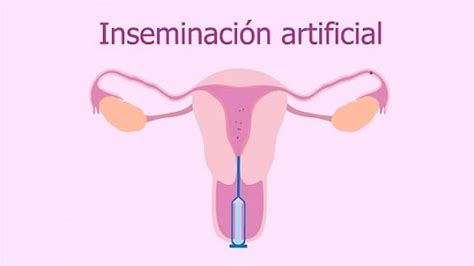 Inseminaci N Intrauterina Tratamiento Especializado En Lima Peru