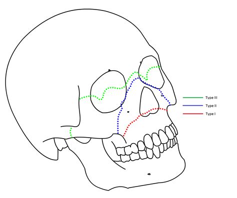 Fracture Occlusofaciale De Le Fort Medg