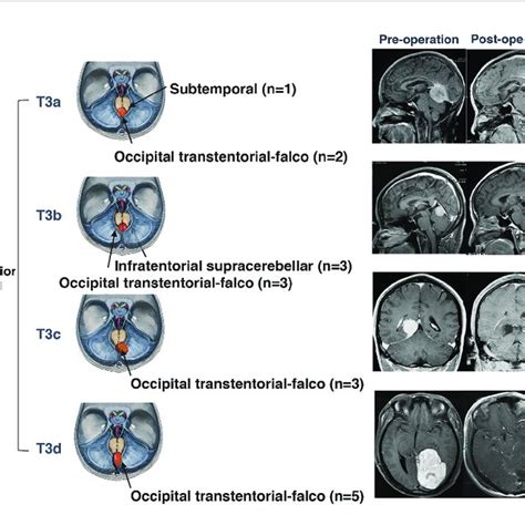 Surgical Approaches And Outcomes Of Posterior Tentorial Notch