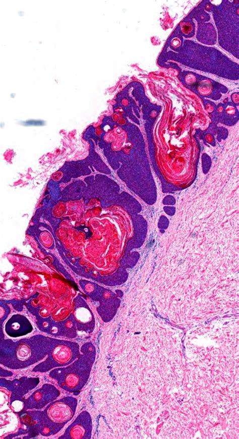 Pin On Dermatopathology Quiz Cases