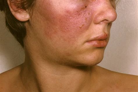 Sjögrens Syndrome Causes Symptoms And Treatment Healthtian