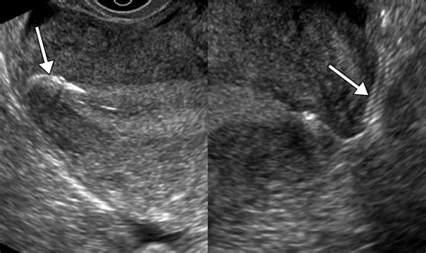 Imaging Evaluation Of Fallopian Tubes And Related Disease A Primer For Radiologists Radiographics